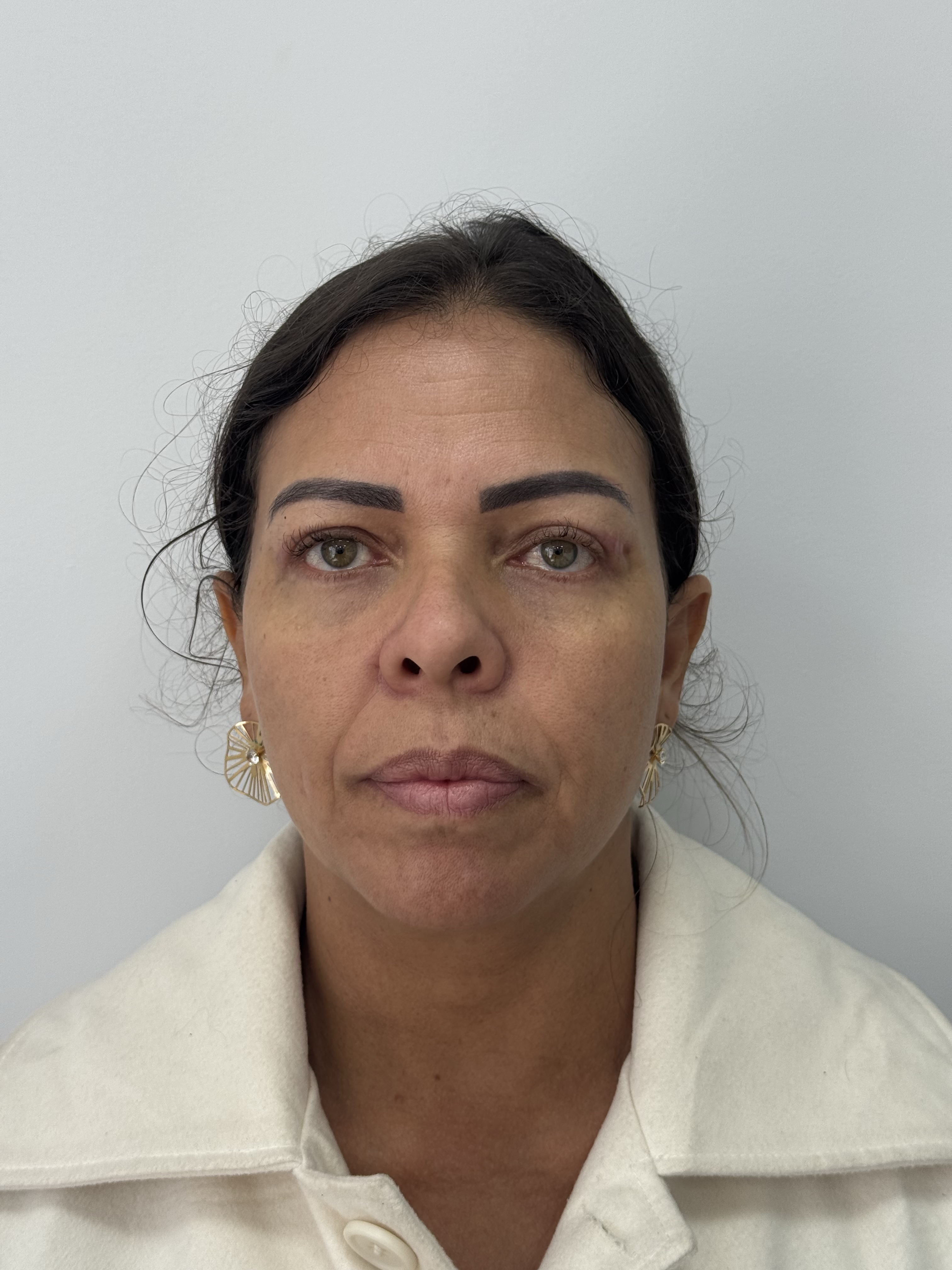 Depois da blefaroplastia superior inferior e castanhares — 60 dias — Stéticos Institute BH