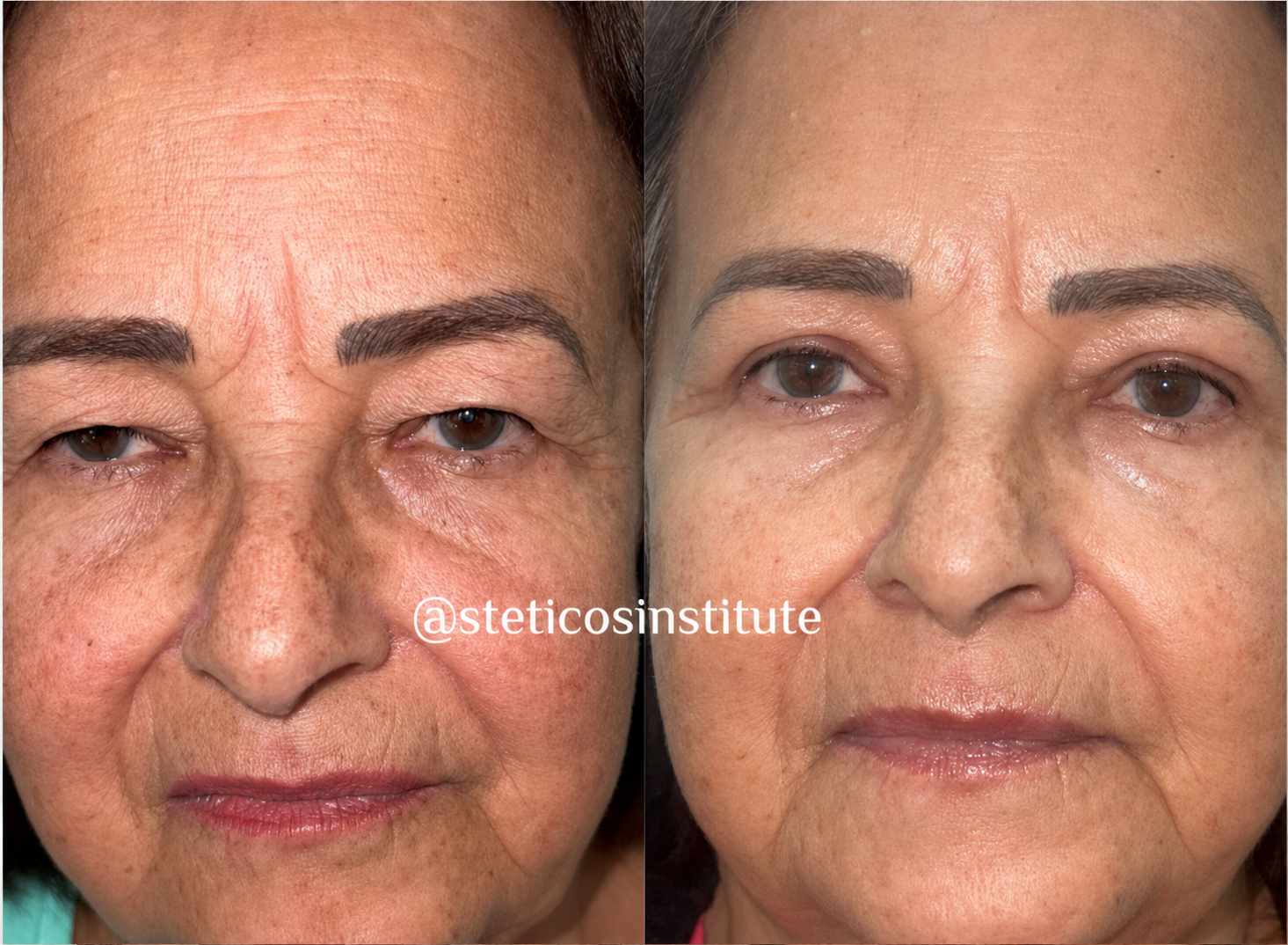 Resultado de blefaroplastia em Belo Horizonte — Antes e depois — Stéticos Institute