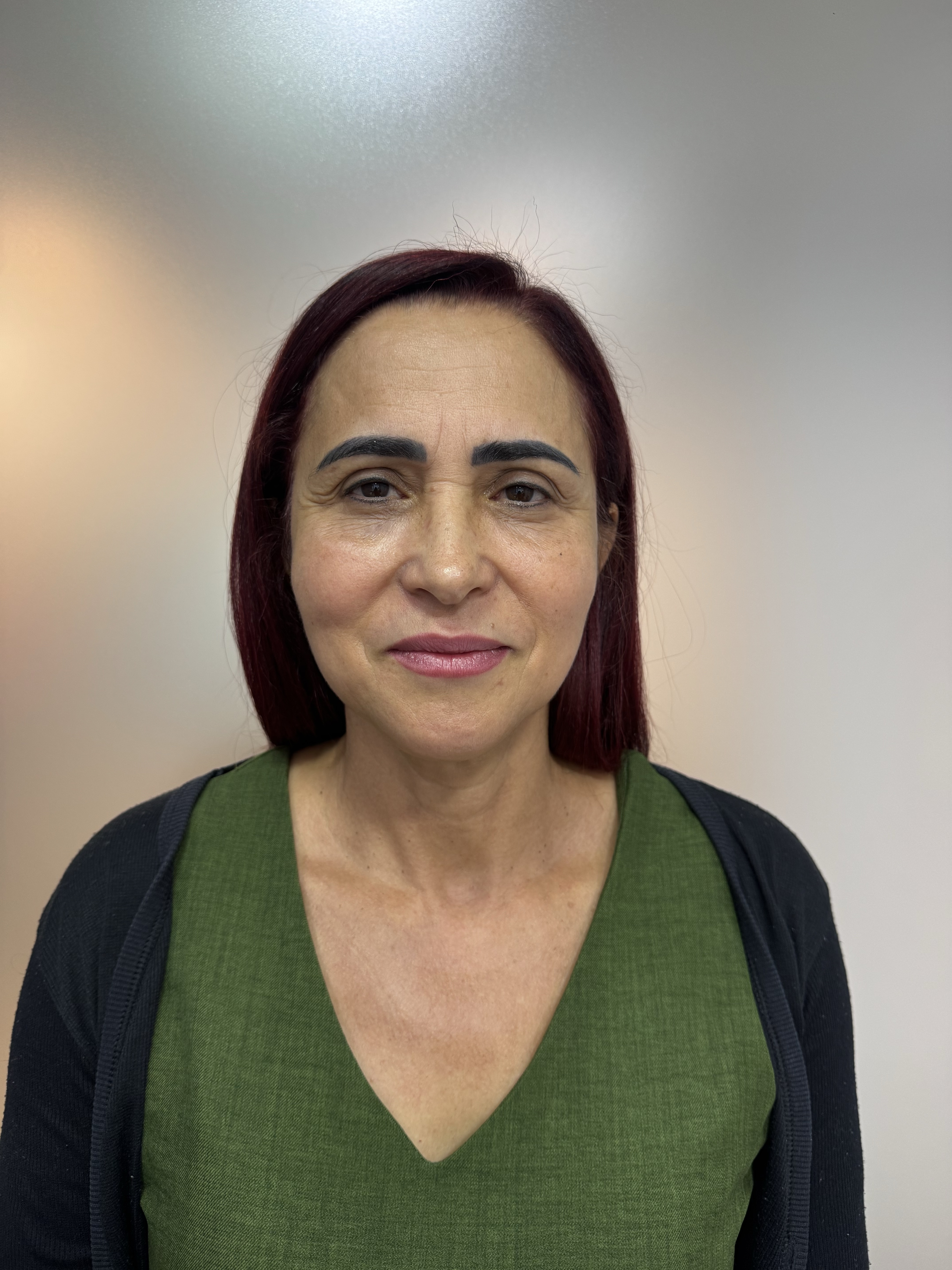 Antes da blefaroplastia superior inferior e castanhares em BH