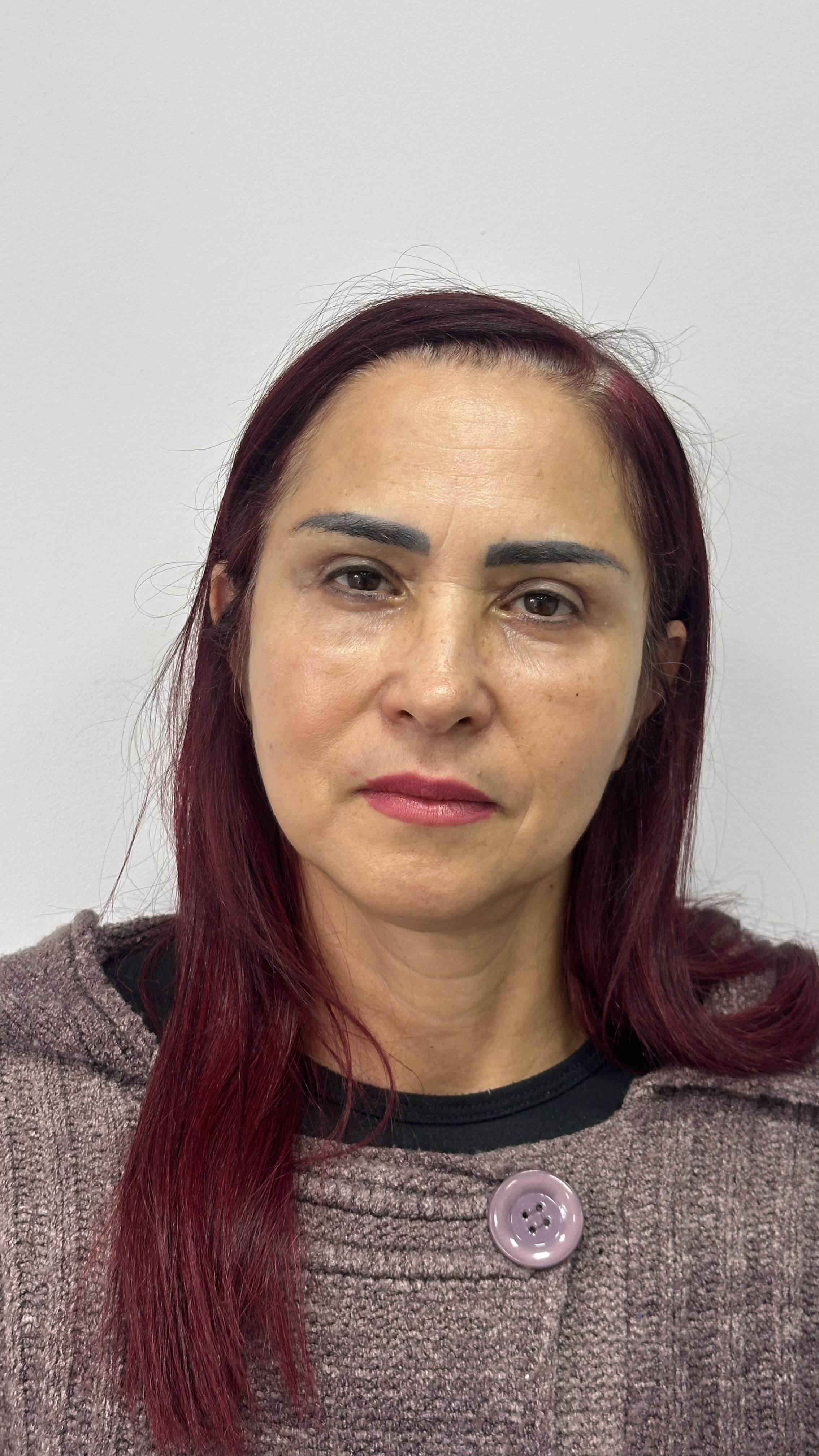 Depois da blefaroplastia superior inferior e castanhares — 30 dias — Stéticos Institute BH