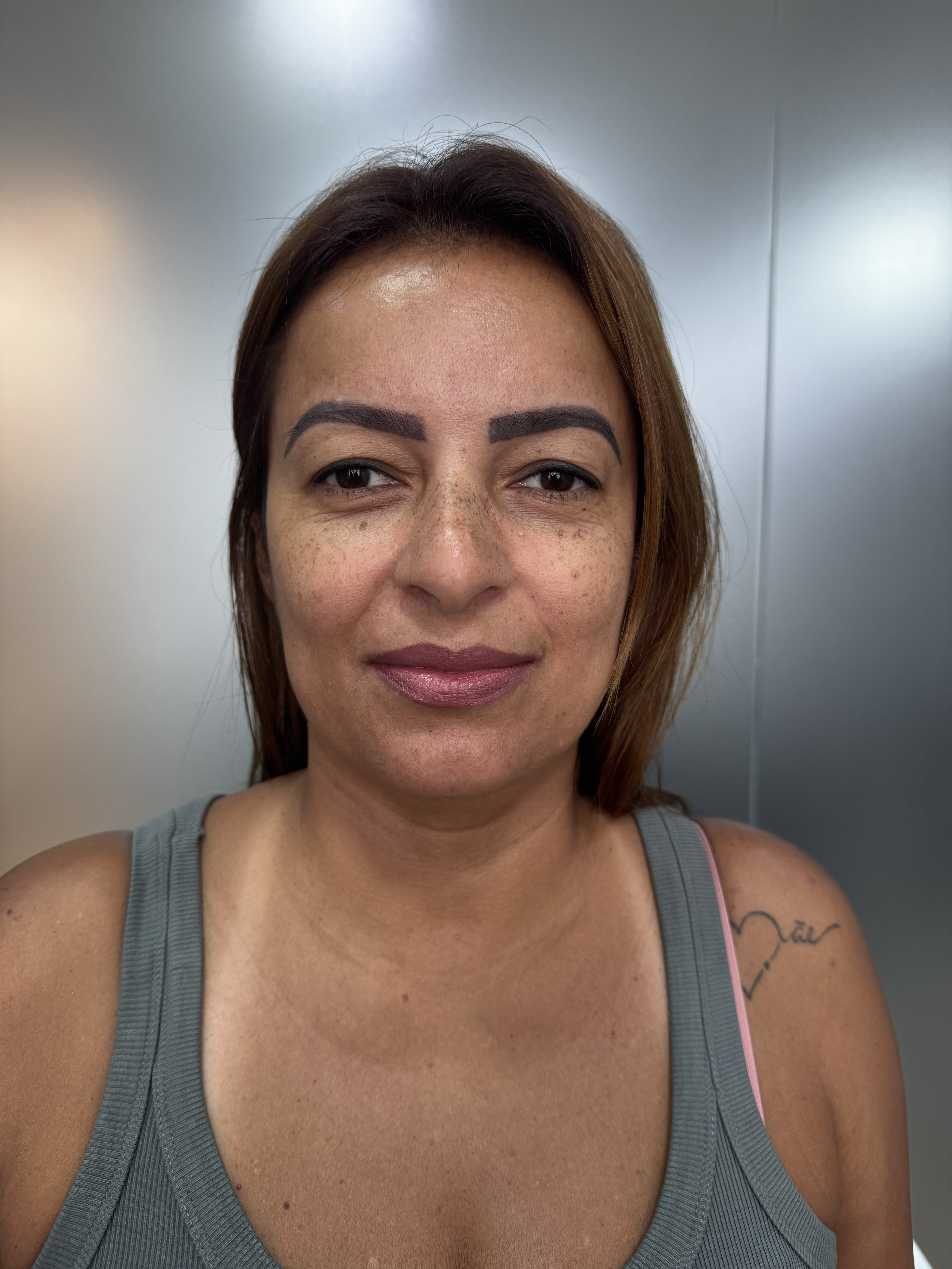Antes da blefaroplastia superior em Belo Horizonte — Stéticos Institute
