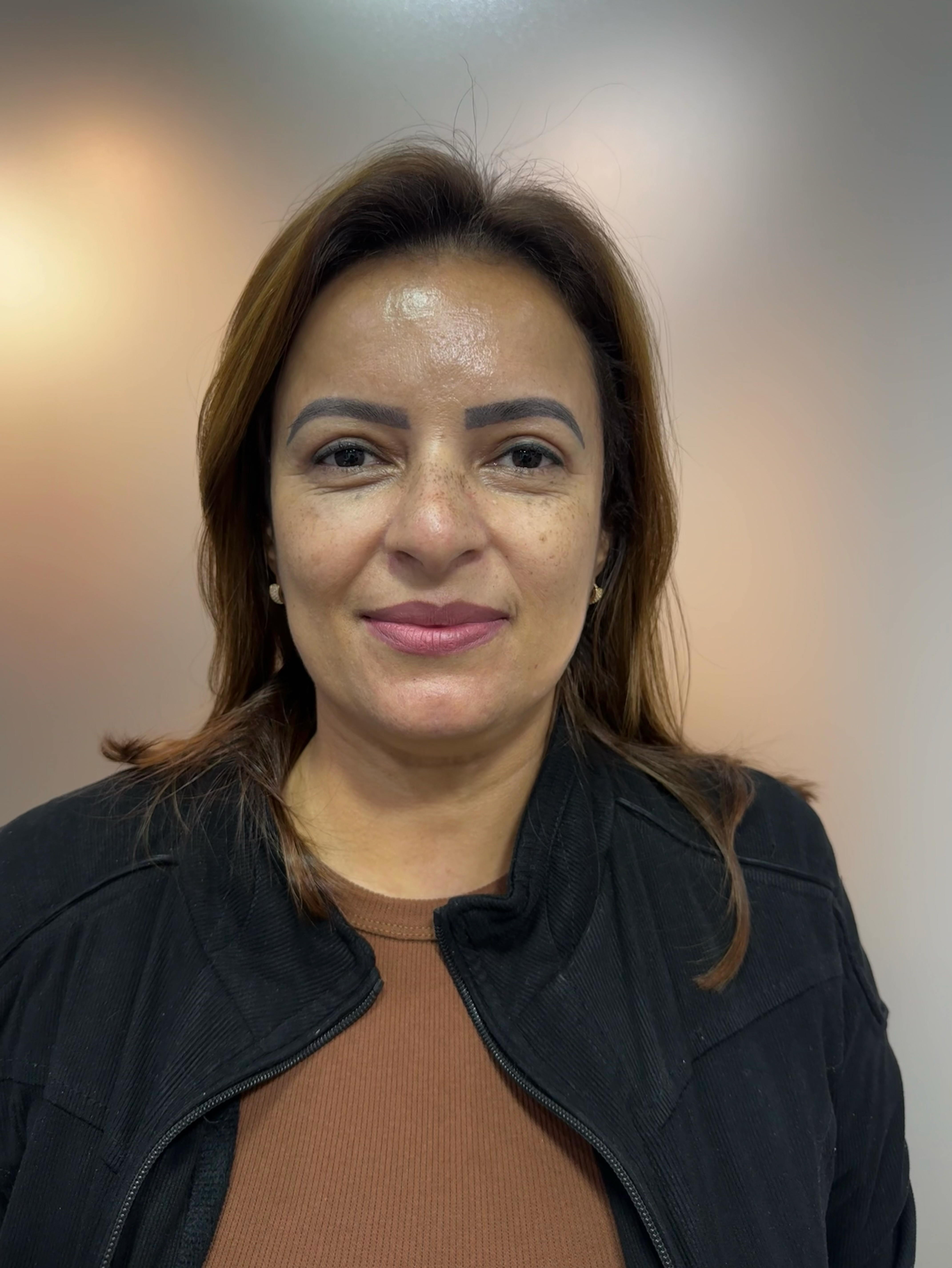 Depois da blefaroplastia superior em BH — resultado com 30 dias — Stéticos Institute